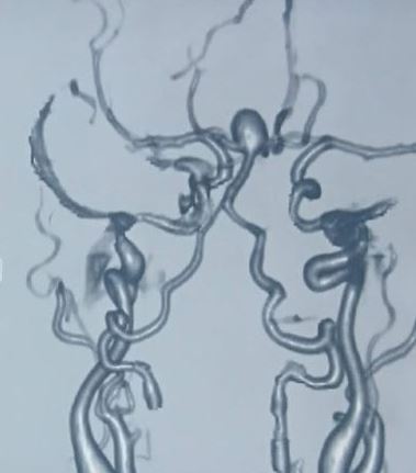 Basilar_tip__aneurysm