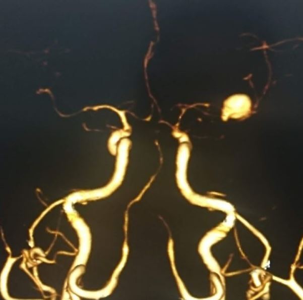 MCA_bifurcation_anerysm