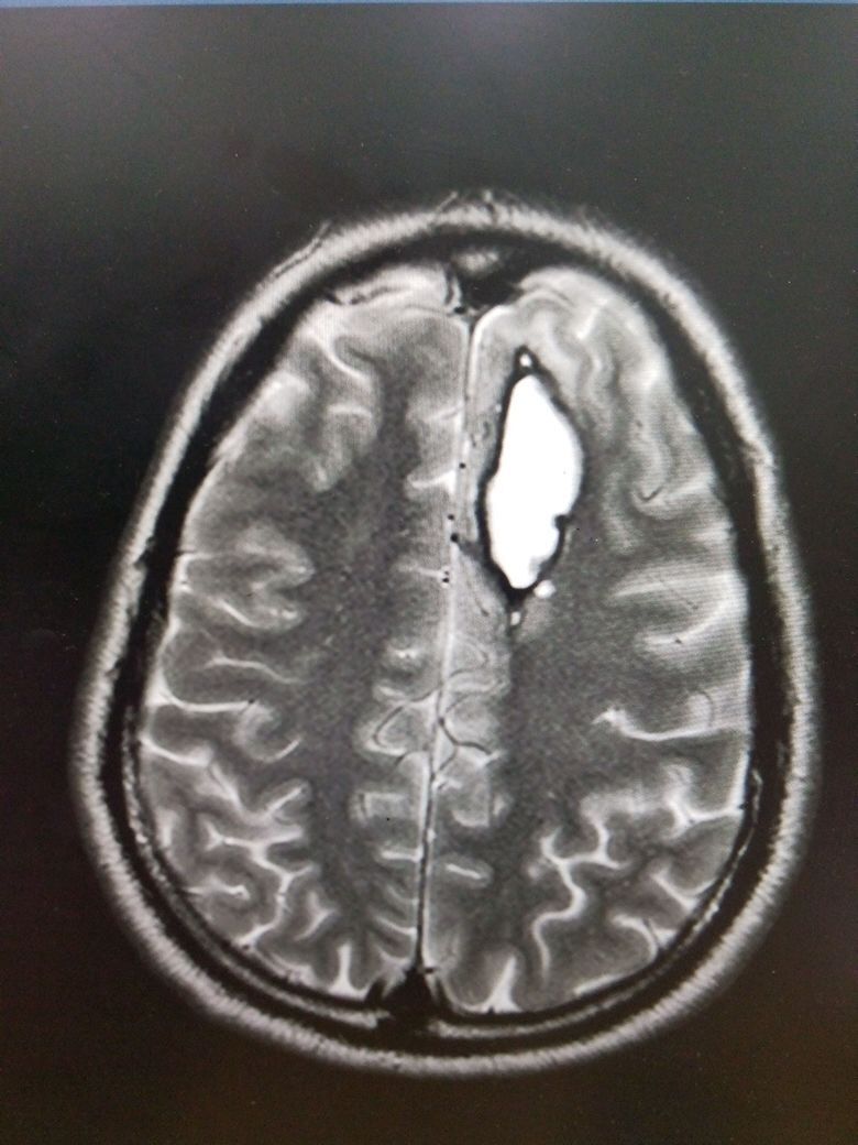 MRI